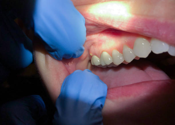 Best Chipped Tooth Repair Near Me  in North Lakeville, MA